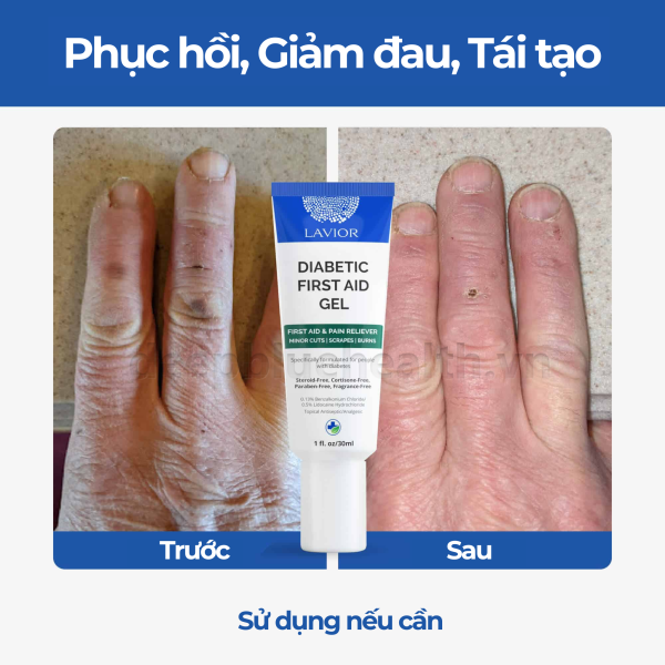 Gel chăm sóc vết thương hở LAVIOR Diabetic First Aid Gel 20ml