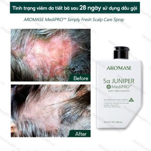 Dầu gội ngăn gàu, giảm viêm chuyên sâu cho da dầu Aromase 5α Juniper MediPRO Simply Fresh Shampoo 80ml 5